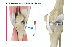 ACL Reconstruction