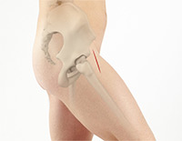  Anterior Hip Replacement