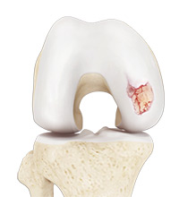 Chondral (Articular Cartilage Defects)