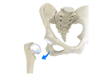 Hip Dislocation