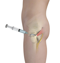 Hip Injections