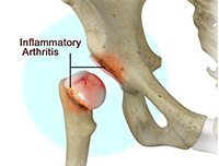 Inflammatory Arthritis of the Hip