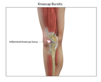 Bursitis