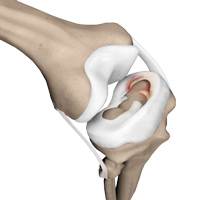 Meniscal Injuries