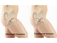 Minimally Invasive Revision-THR Anterior Approach