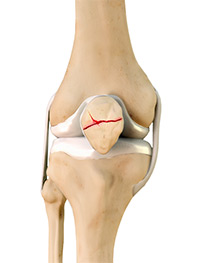 Patella Fracture