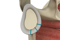 Shoulder Labrum Reconstruction