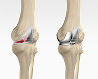 Unicompartmental Knee Replacement