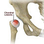 Chondral Lesions or Injuries