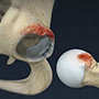 Femoroacetabular Impingement