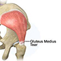 Gluteus Medius Tear