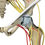 Avascular Necrosis