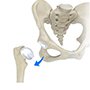 Hip Dislocation