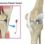 ACL Reconstruction Patellar Tendon