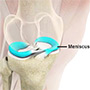 Meniscal Surgery