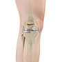 Knee Fractures