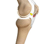 Patellar Tendinitis