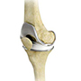 Total Knee Replacement