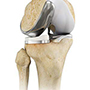 Unicompartmental Knee Replacement