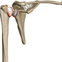 Arthritis of the Shoulder